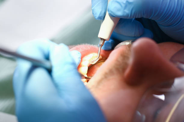 Best Emergency Dental Care for Broken or Chipped Teeth in Waukesha, WI