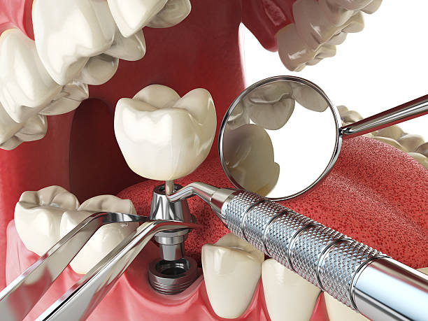 Best Emergency Treatment for Dental Infections or Abscesses in Waukesha, WI