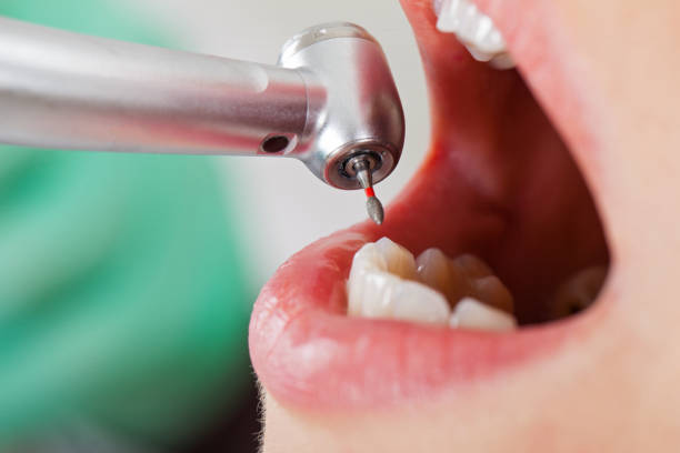 Best Emergency Dental Care for Broken or Chipped Teeth in Waukesha, WI